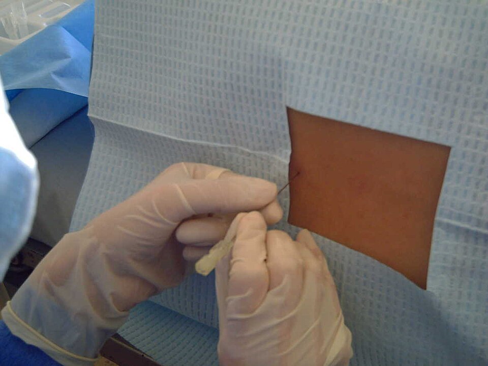 A lumbar puncture performed through a sterile drape